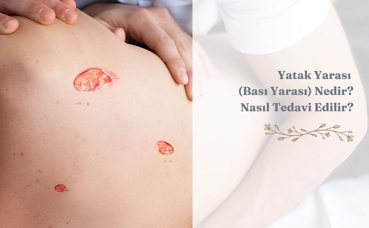 Yatak Yarası (Bası Yarası) Nedir? Nasıl Tedavi Edilir? 1 Yatak Yarasi Basi Yarasi Nedir Nasil Tedavi Edilir